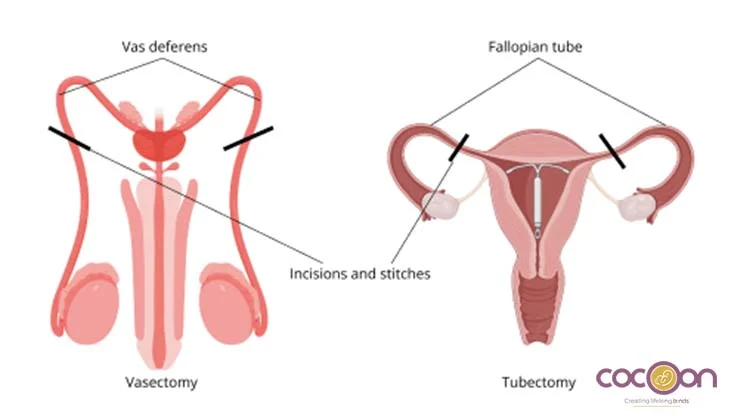 Tubal Ligation Explained: Procedure, Recovery, Reversal & How It Compares to Vasectomy
