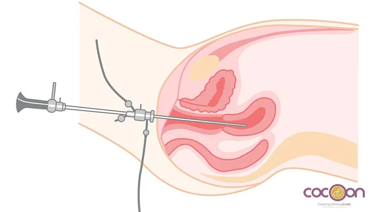 Myomectomy Vs. Hysterectomy: Which Fibroid Treatment Is Right For You?
