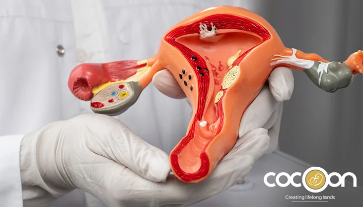 Uterine Fibroids: Symptoms, Causes, and Effective Solutions