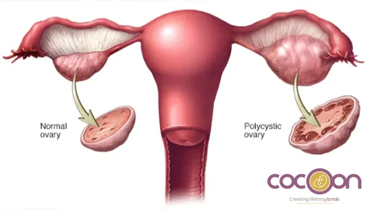 How Does PCOD and PCOS Differ? How Does Each Condition Affect Our Body?